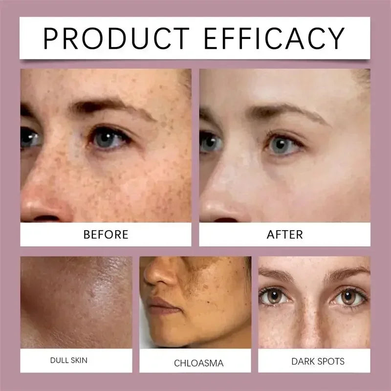 Whitening Freckle Melasma Dark Spots Pigmentation Removal Cream - Palm and Thread