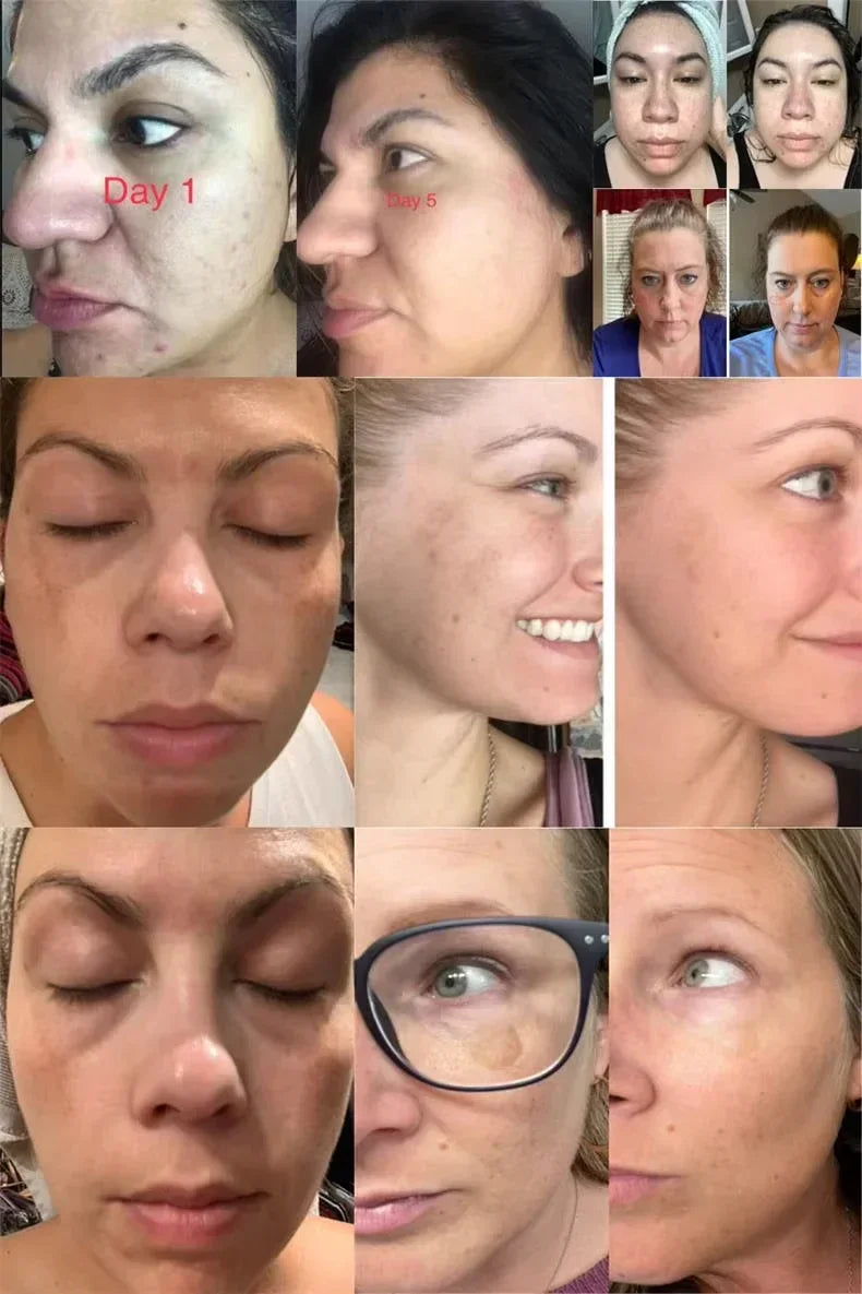 Whitening Freckle Melasma Dark Spots Pigmentation Removal Cream - Palm and Thread