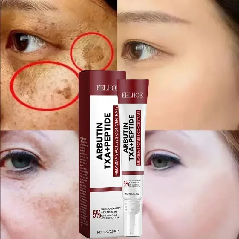 Whitening Freckle Melasma Dark Spots Pigmentation Removal Cream - Palm and Thread