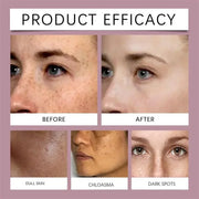Whitening Freckle Melasma Dark Spots Pigmentation Removal Cream - Palm and Thread