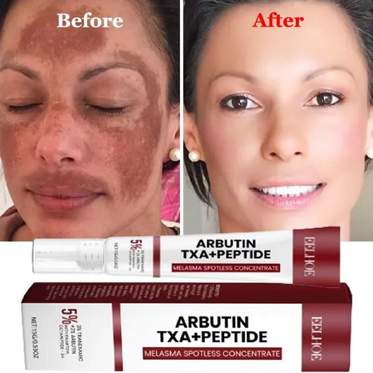Whitening Freckle Melasma Dark Spots Pigmentation Removal Cream - Palm and Thread